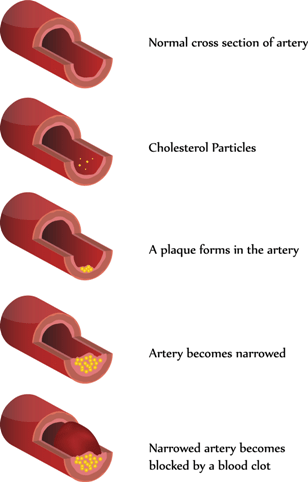 Coronary_Artery_Disease