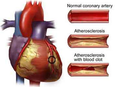 coronary-artery-disease